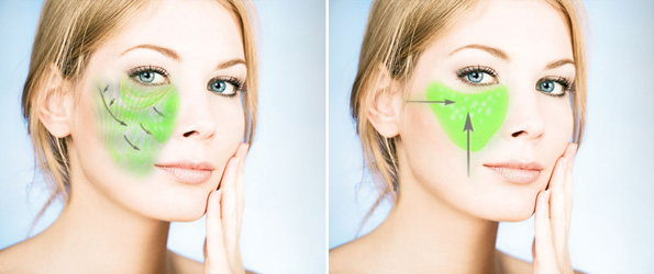 Face Lift - Chirurgien esthétique Paris