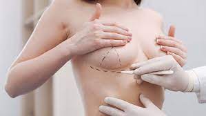 Réduction mammaire avant après réalisé à Paris par le Dr Faivre