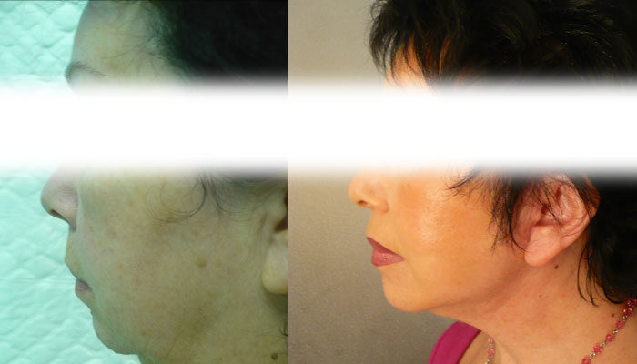 Face lift / lifting du visage résultat et cicatrice